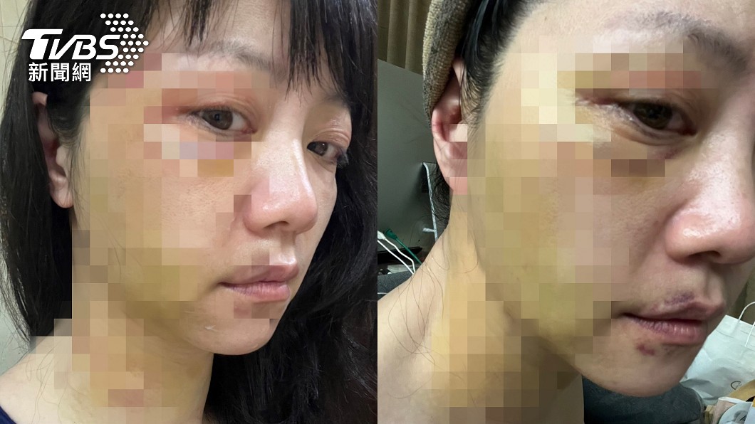 立委高嘉瑜遭男友施暴。(圖/高嘉瑜提供)