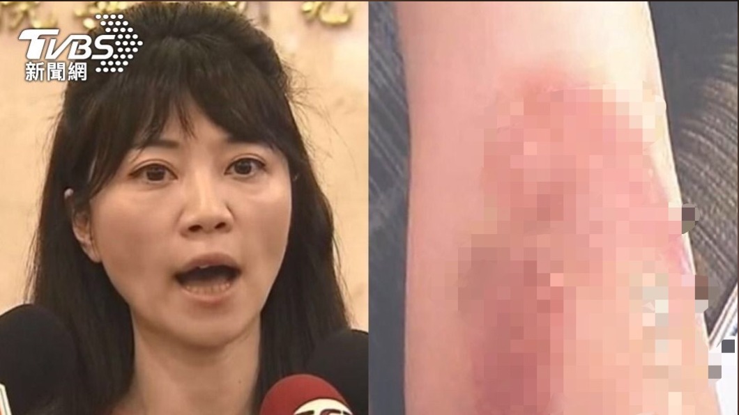 高嘉瑜遭揮拳打眼、手勒脖!恐有後遺症 醫:這傷最難好