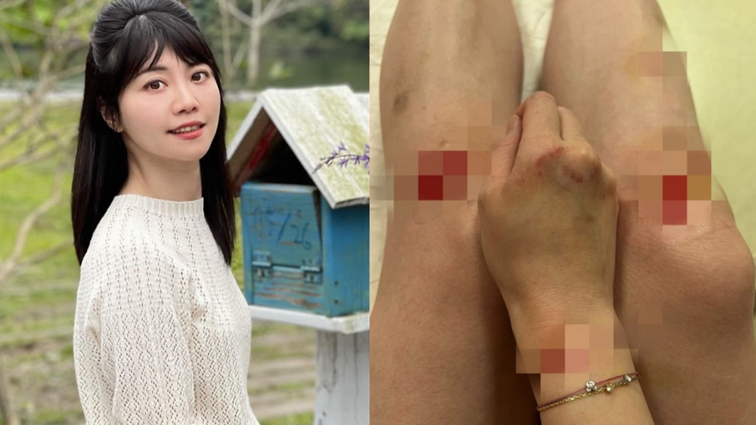 高嘉瑜遭到男友暴力相向。(圖/翻攝自高嘉瑜臉書、高嘉瑜提供)