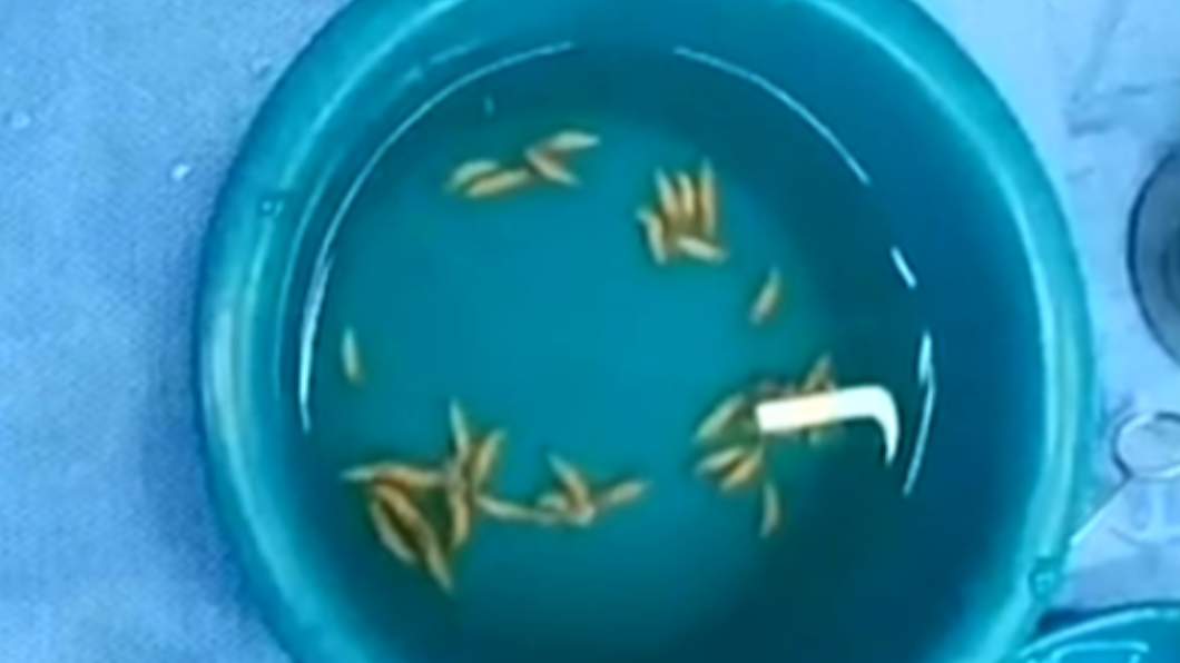 挖鼻孔蟲卵跑進去?陸翁哀號吃不下 挖出36條超肥活蛆