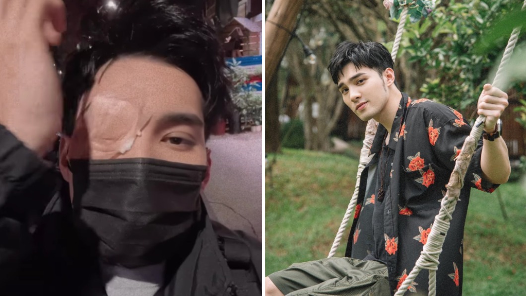 男星「右眼莫名淤青」急衝眼科!下秒直接開刀 近況曝光