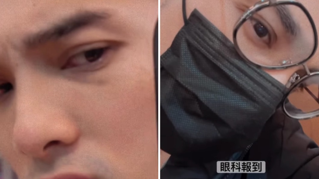 黃偉晉右眼驚見瘀青。(圖/翻攝自黃偉晉IG)