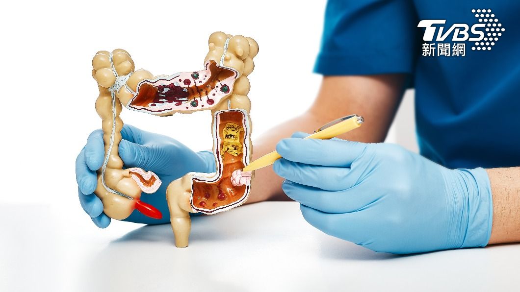 晚期轉移性大腸癌患者，治療前檢測是否有「RAS」基因突變。（示意圖／shutterstock達志影像）