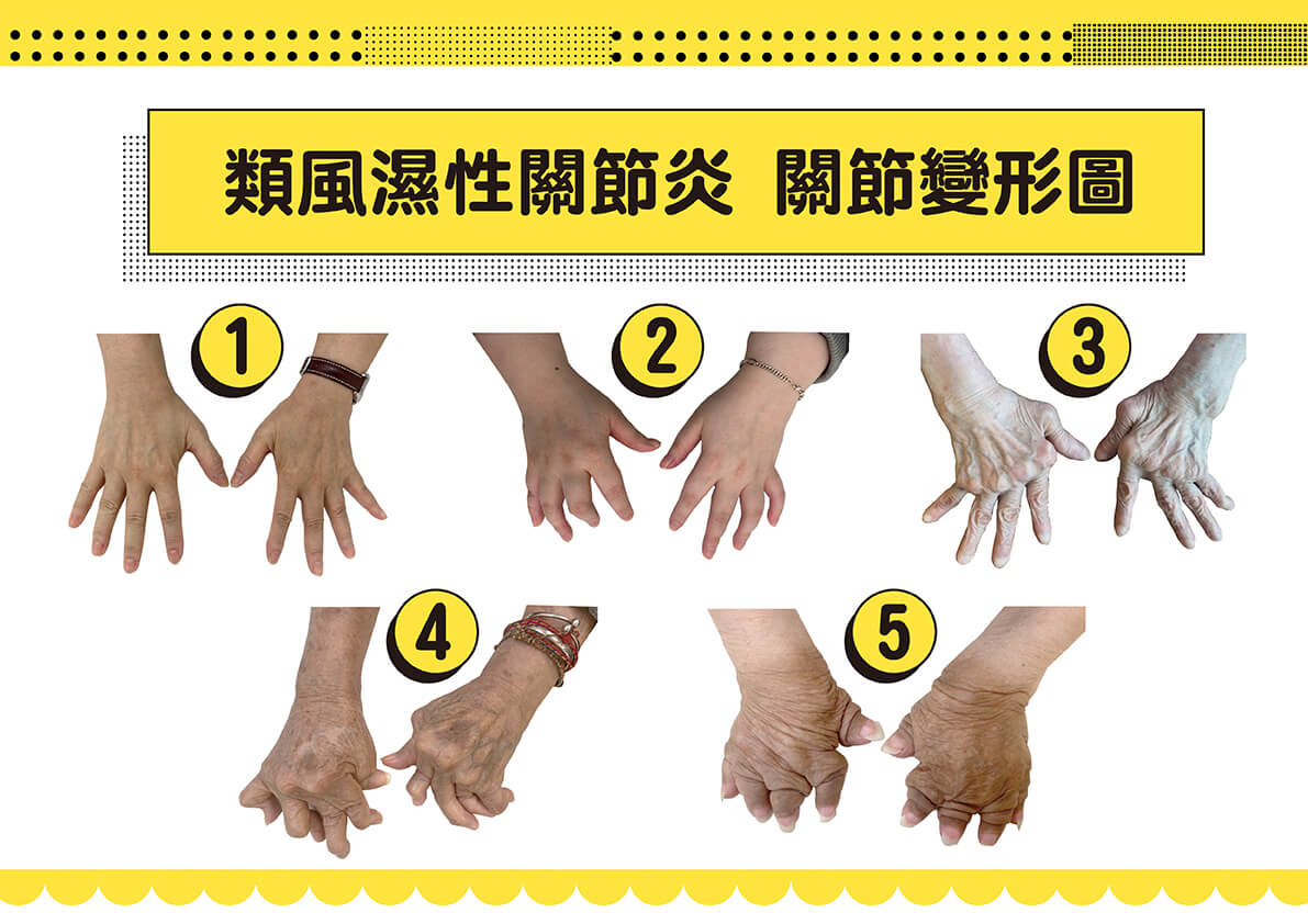 類風濕性關節炎,關節變形圖。(圖/北市榮總蔡長祐主任提供)