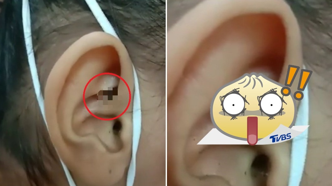 男童狂喊耳朵痛！　醫驚見「密麻黑點」嚇：這隻超肥