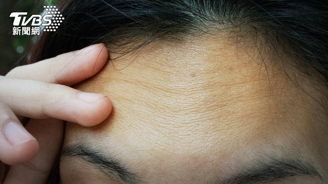 抬頭紋可能是徵兆。 （示意圖／shutterstock達志影像）