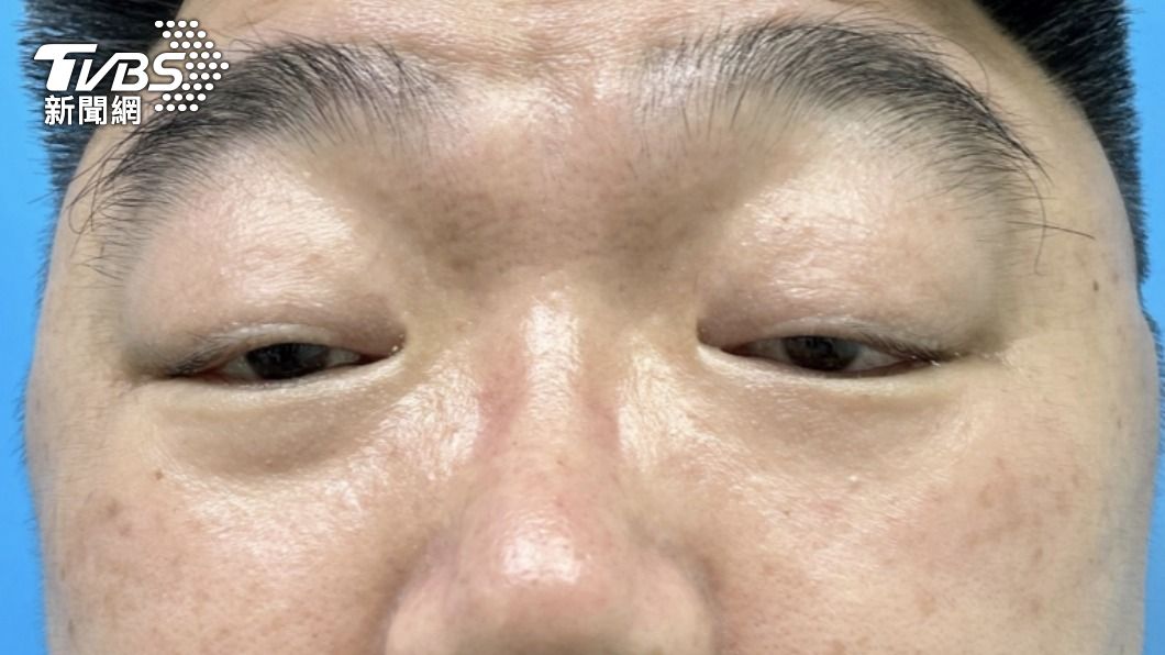 天生瞇眼像「度咕」!他老被罰站 雙眼睜開僅0.1公分