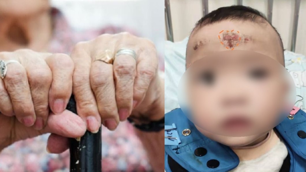 孫女咳不停!外婆拿戒指「刮痧祛寒」 害頭破皮潰爛