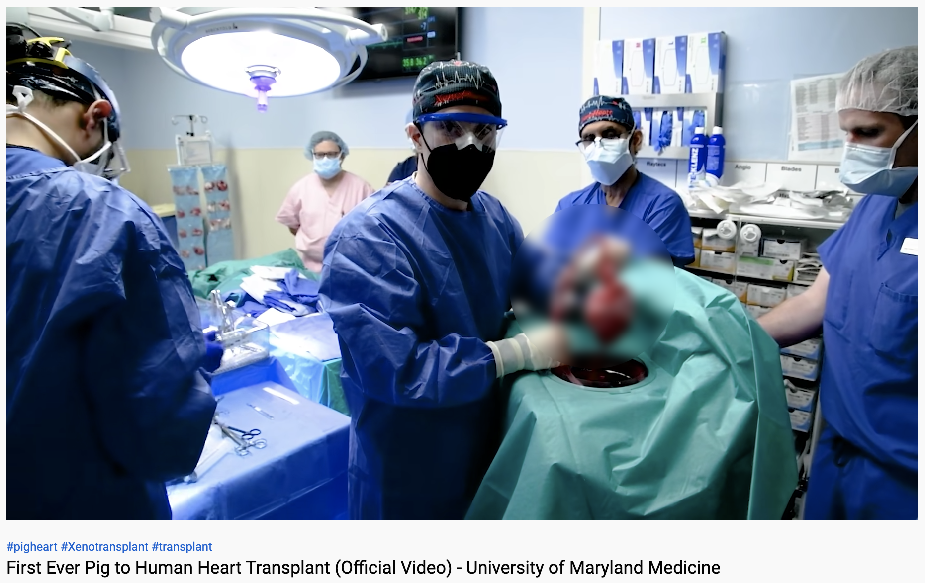 美國醫學史上首例豬心移植手術。(圖/翻攝自YouTube「University of Maryland School of Medicine」)