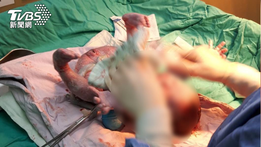 生死交關180秒！醫驚見「這東西」滑進產道　嬰險缺氧喪命　