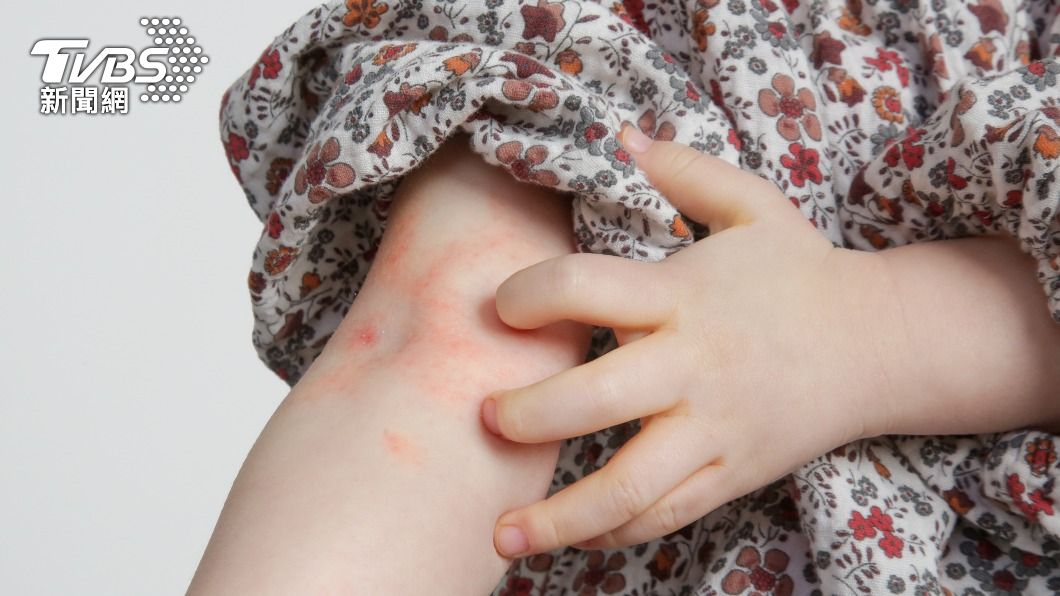 拆解兒童異位性皮膚炎!醫「教戰5招」少癢少傷身