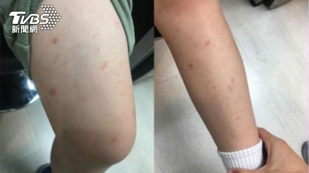 家長注意!孩子腿部爬滿「不明紅疹」勿輕忽 嚴重恐釀腎衰竭