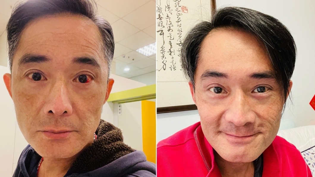藝人江國賓因長時間拍戲數度眼睛爆血管。（圖／翻攝自江國賓臉書）