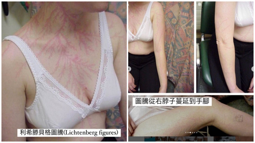 英國一名女子日前遭雷擊後身上出現「利希滕貝格圖騰」。(圖/翻攝自IG@drjohnchueh)