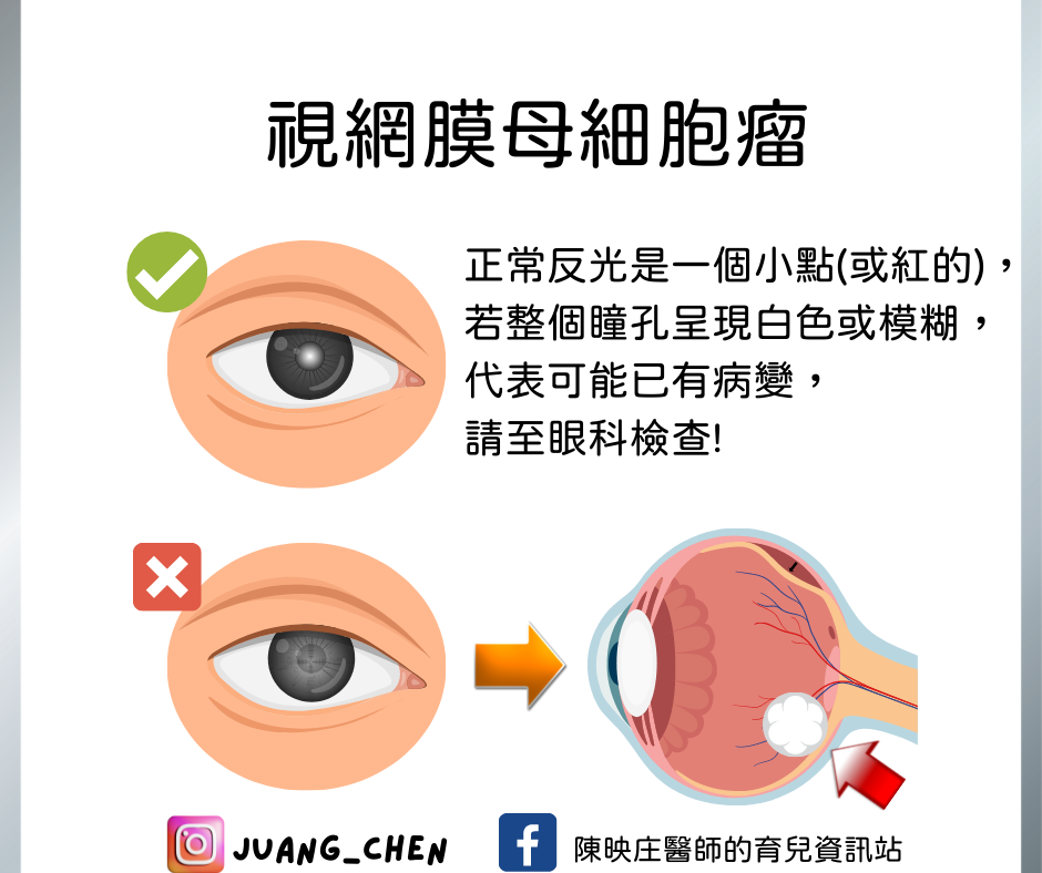 視網膜母細胞瘤檢查。(圖/翻攝自陳映庄醫師的育兒資訊站臉書)