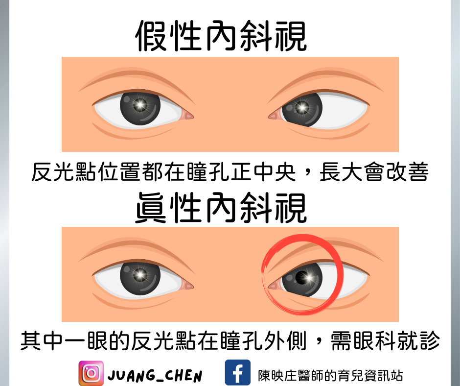 真性內斜視檢查。(圖/翻攝自陳映庄醫師的育兒資訊站臉書)