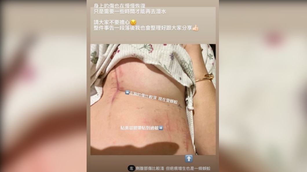 Amber目前身上還留有傷疤。(圖/Amber提供)