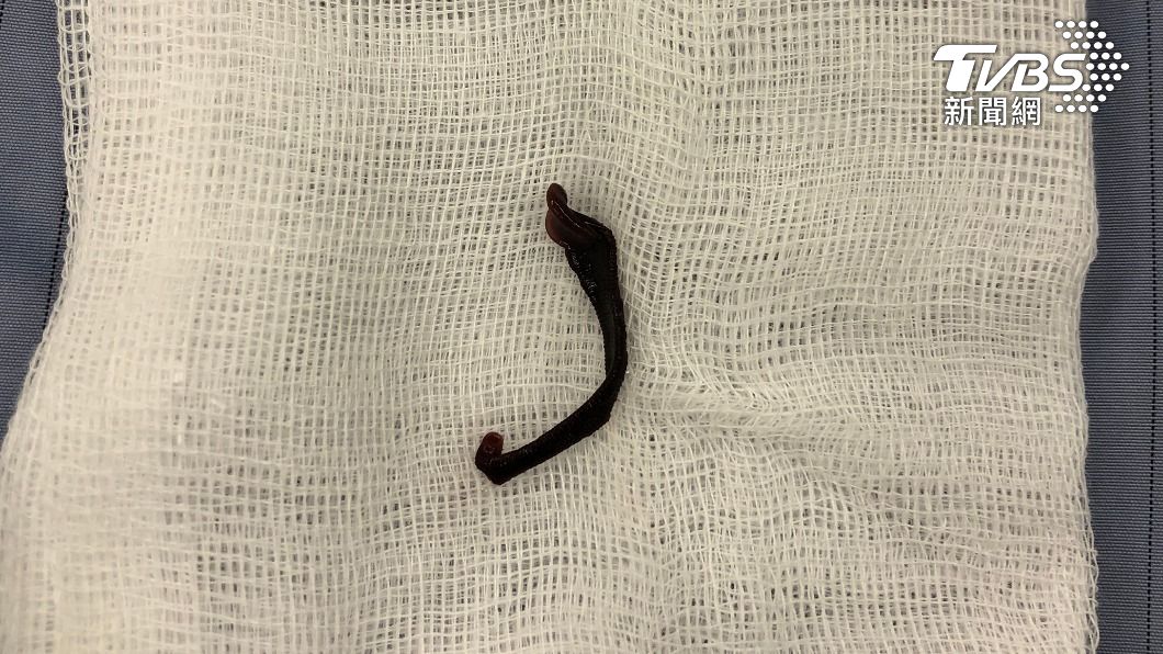 鼻孔內黑頭鑽動!女童間歇鼻血急就醫 一看竟是鼻蛭作怪