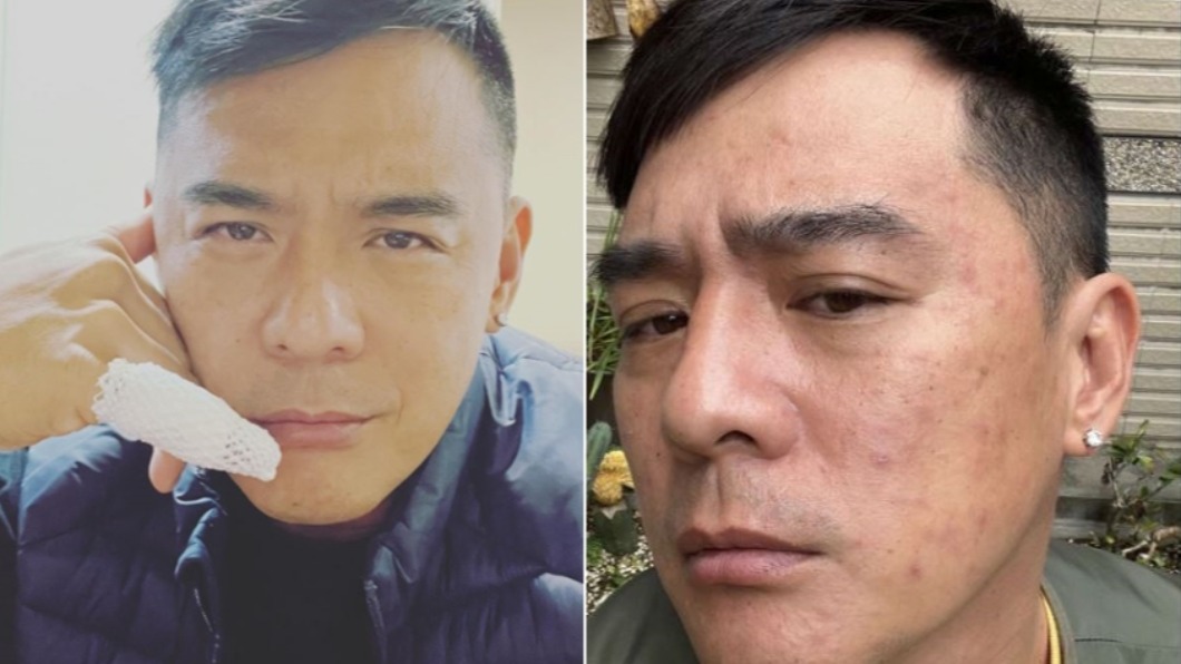 竇智孔高燒38度!全身紅疹險「送加護病房」再晚恐喪命