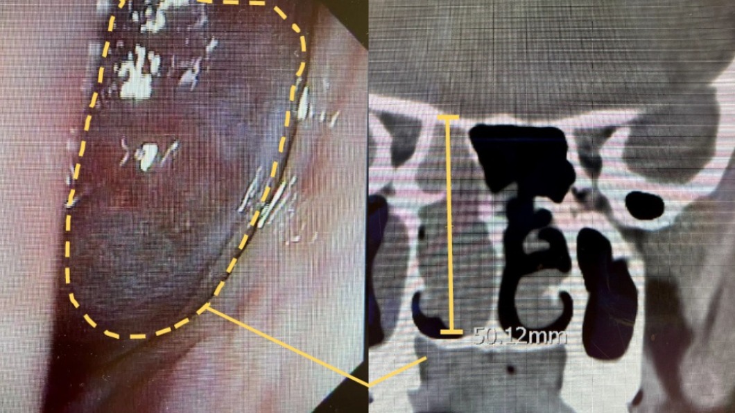 流血絲鼻涕以為鼻竇炎 男就醫罹罕見癌「嚴重恐失明」