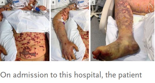 男學生感染流行性腦脊髓膜炎，敗血症併發多重器官衰竭，截肢保命。（圖／翻攝自《新英格蘭醫學雜誌》）