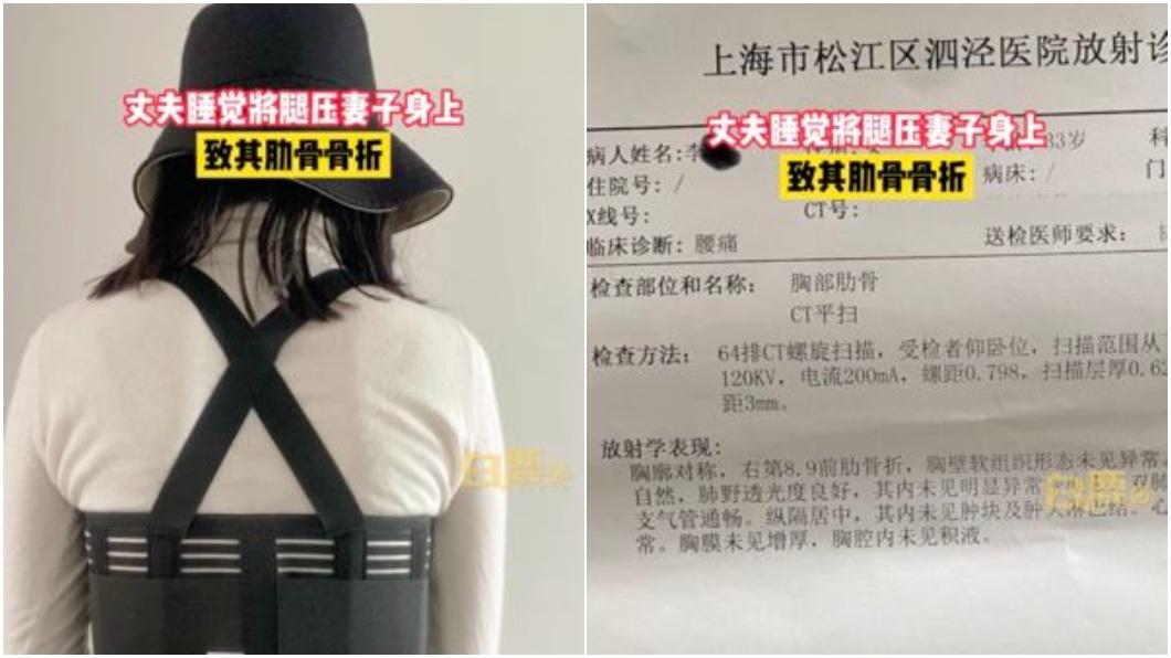 人妻懷疑是丈夫睡覺時把腿壓在她身上才會導致肋骨骨折。（圖／翻攝自網易新聞）