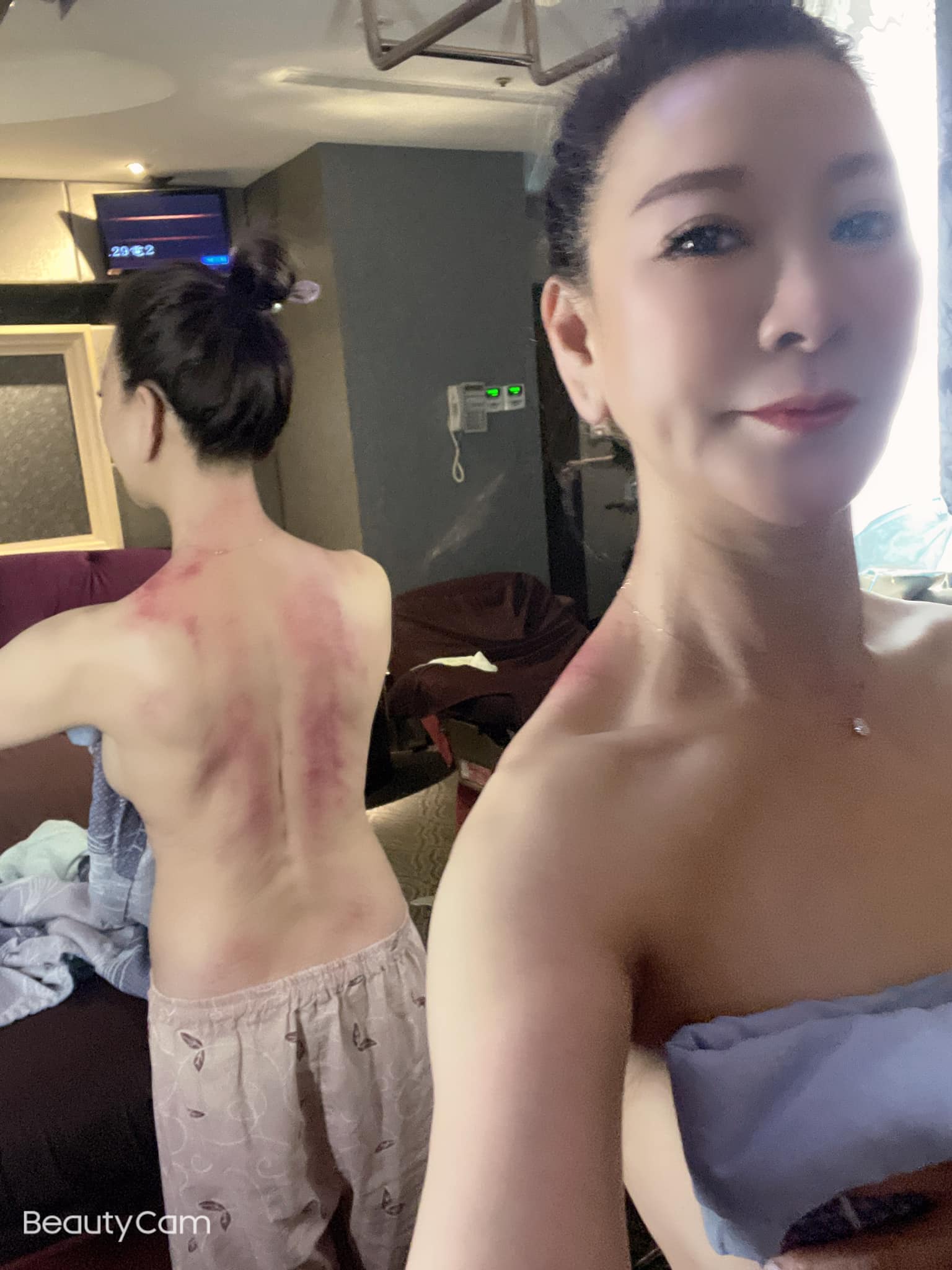 楊繡惠曬出刮痧成果。(圖/翻攝自楊繡惠臉書)
