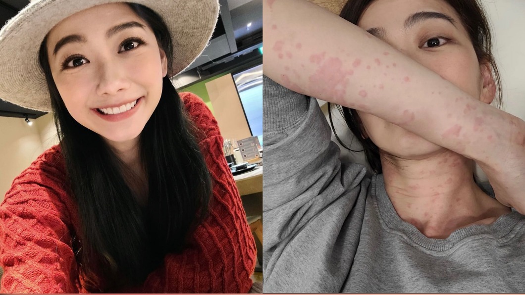 全身長滿紅斑急就醫!邵庭親揭病況嘆:不珍惜身體遭反噬