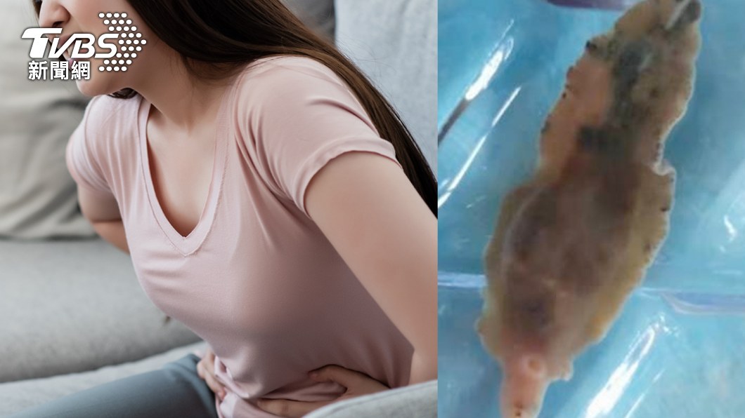 女腹痛「肝臟」竟遭吃三分之一！醫見巨蟲驚喊：太罕見
