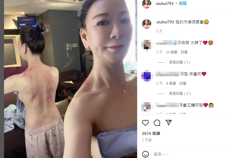 楊繡惠曬出刮痧照。(圖/翻攝自楊繡惠IG)