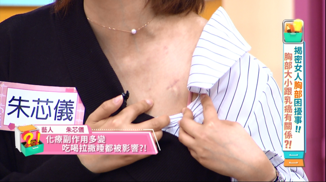 朱芯儀大方秀出身上的人工血管。（圖／東森提供）