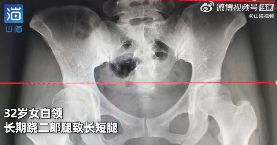 檢查發現她出現長短腳兩者相差1.5公分。（圖／翻攝自山海視頻）