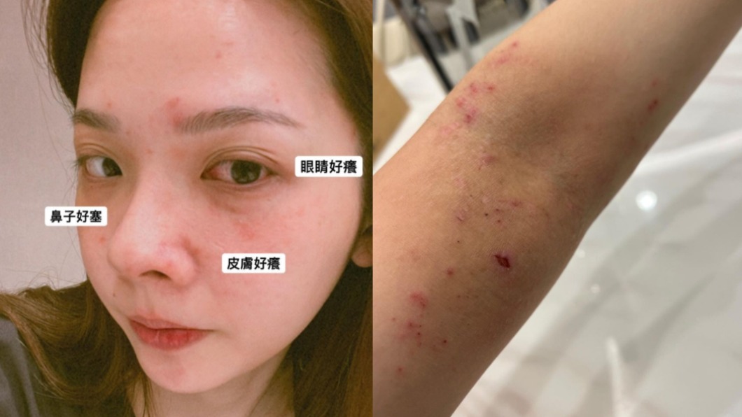 滴妹因為過敏導致起紅疹超癢。(圖/翻攝自滴妹IG)