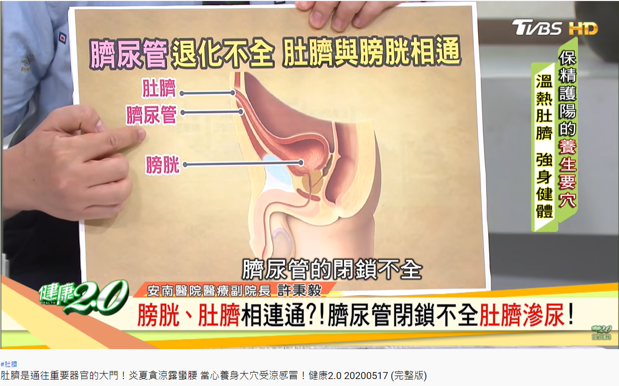 許秉毅指出,女子有「臍尿管閉鎖不全」的問題。(圖/翻攝自健康2.0YouTube)