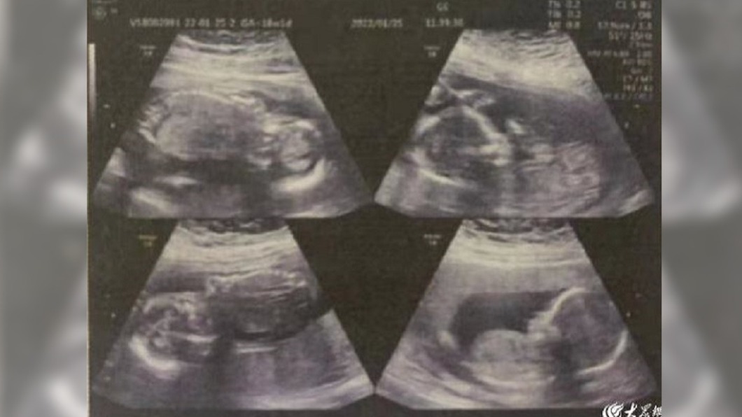 才生完大寶「4天後再產男嬰」!嫩媽崩潰:還有2孩在腹中