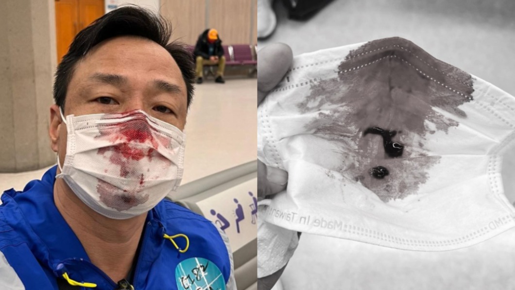 港星王喜入境台灣爆意外!鼻子「被捅爆血」:PCR陽性