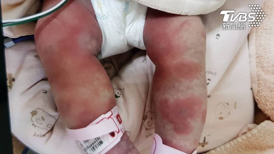 女嬰發燒險敗血症亡！　醫揭「泡奶1習慣」感染奪命細菌