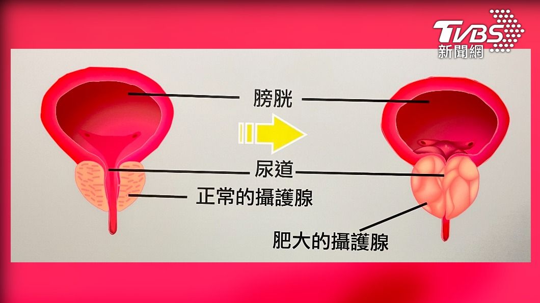攝護腺和肥大的增生組織就像「一顆柑橘」(東元醫院提供)