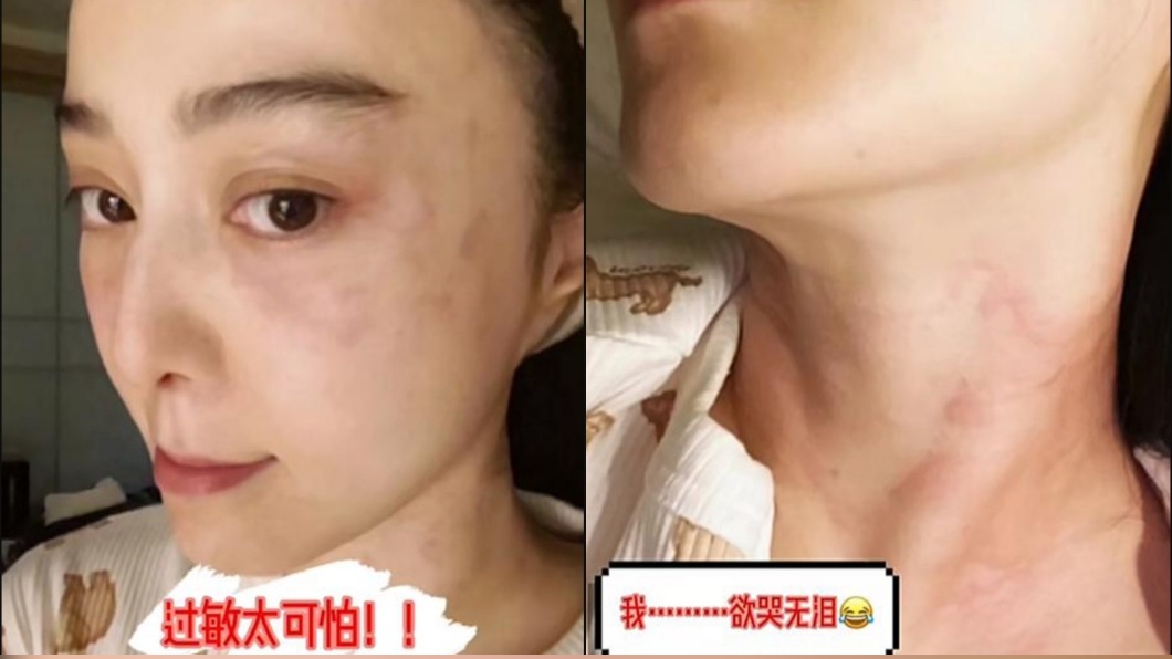 范冰冰日前貼出自己的臉部過敏狀況。（圖／翻攝自范冰冰小紅書）