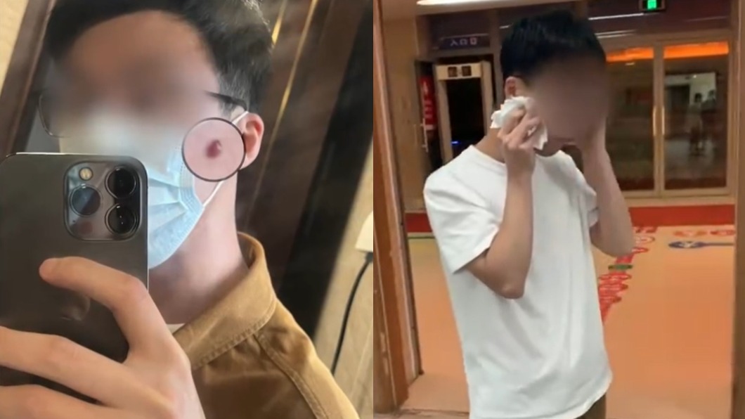 臉上冒巨痘!男手癢摳破「大噴血」 檢查竟是血管瘤
