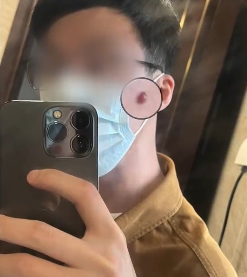 男子臉上冒出巨痘。(圖/翻攝自微博)