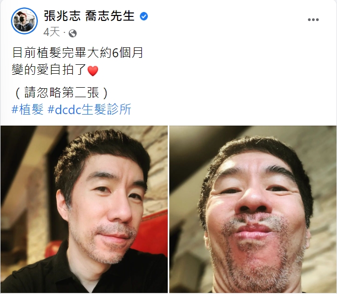 張兆志分享植髮的成果。（圖／翻攝自張兆志臉書）