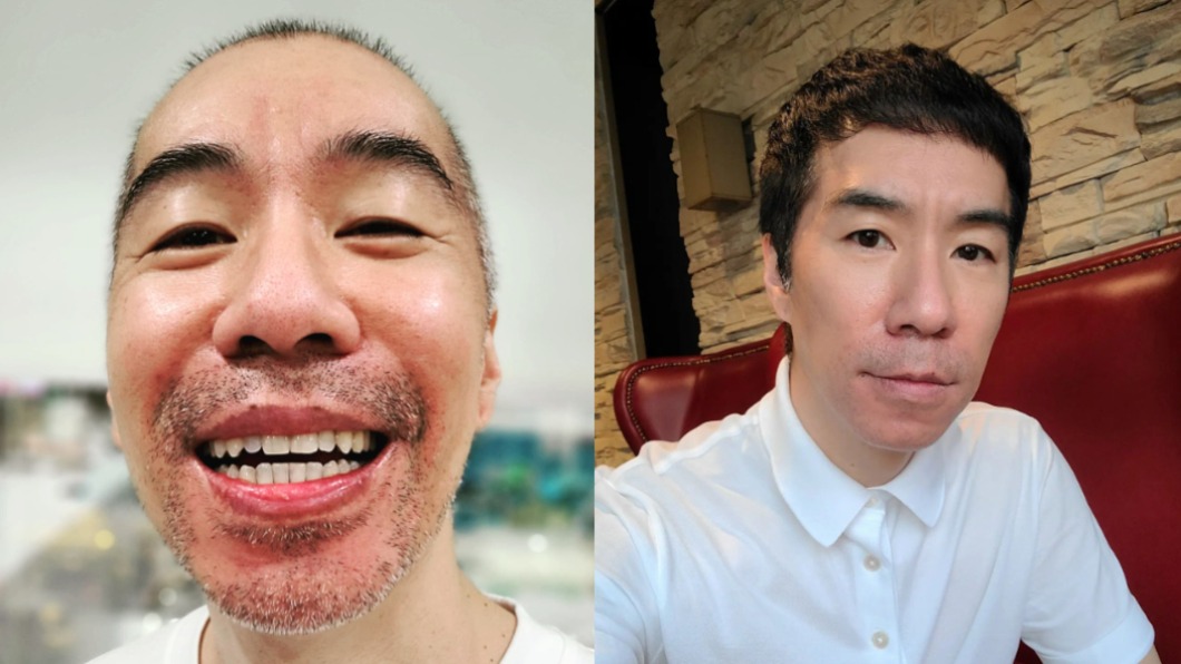 禿頭掰!張兆志豪砸57萬 植「7千根頭毛」逆齡模樣曝