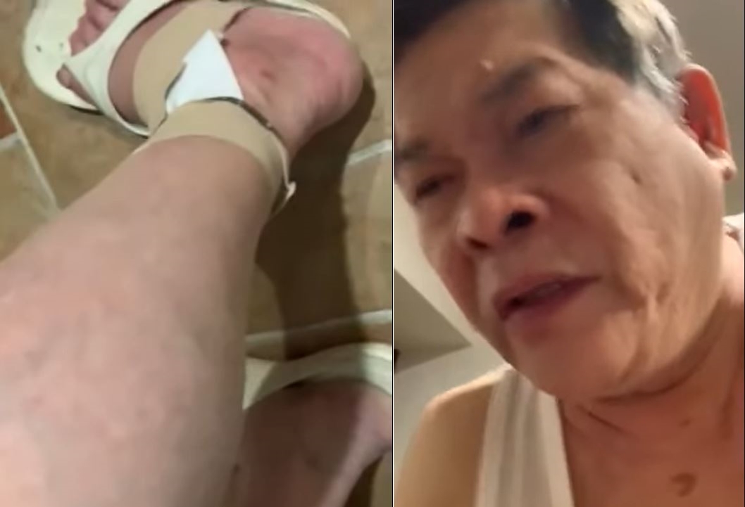 澎恰恰5月摔倒,腳掌整個反折。(圖/翻攝自澎恰恰臉書)