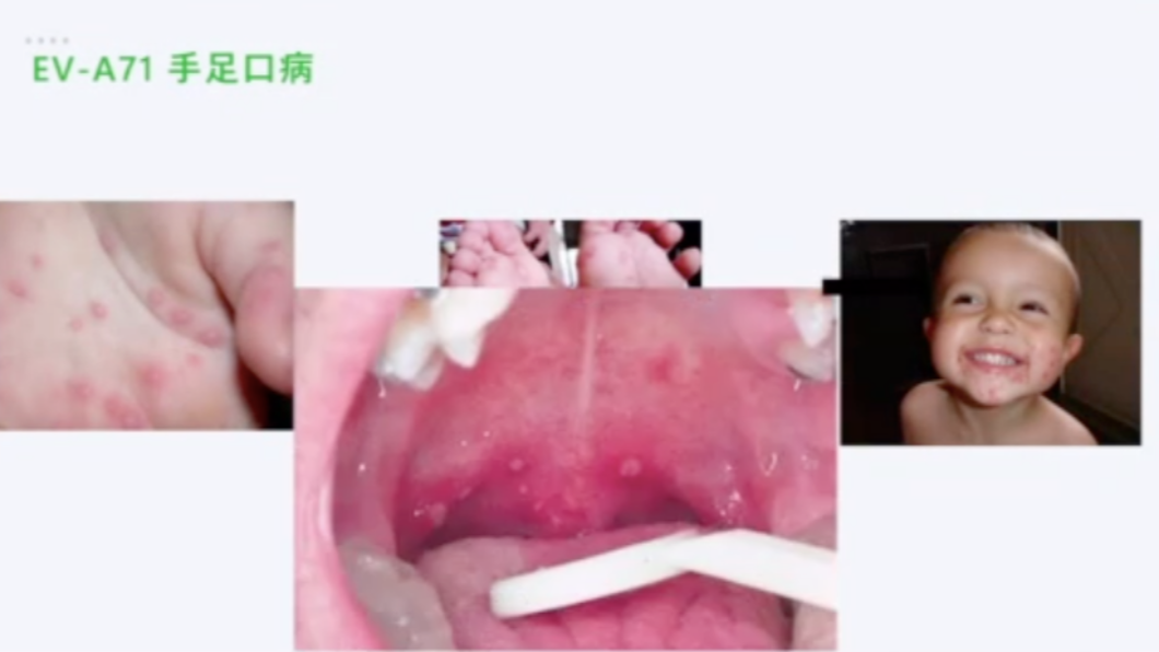 腸病毒71型造成孩童手足口病,重症率高。(圖/台大醫院提供)
