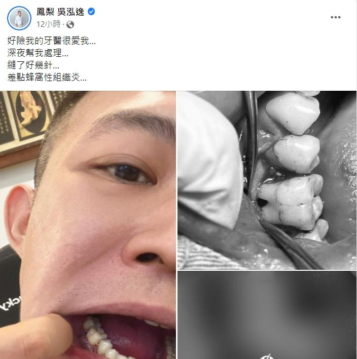 鳳梨透露差點就釀成蜂窩性組織炎。(圖/翻攝自鳳梨吳泓逸臉書)