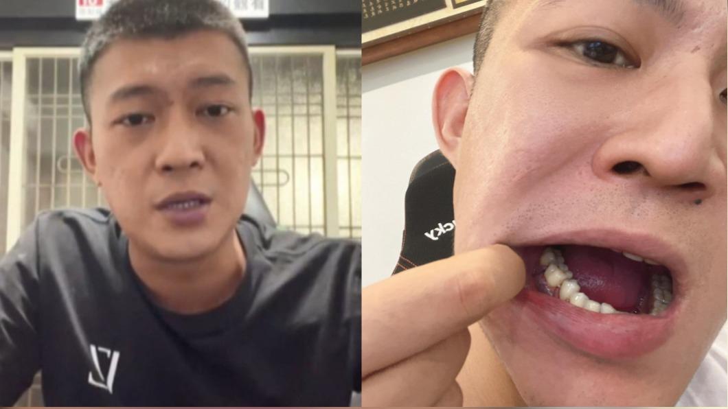 鳳梨深夜急奔醫院!「滿嘴鮮血」畫面曝:差點蜂窩性組織炎