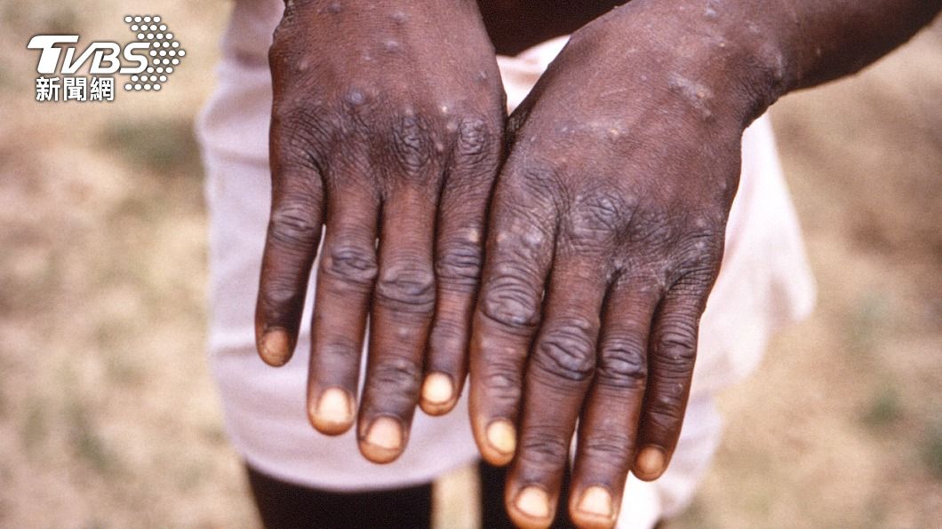 葡萄牙發現5例猴痘感染個案 英國再添2宗病例