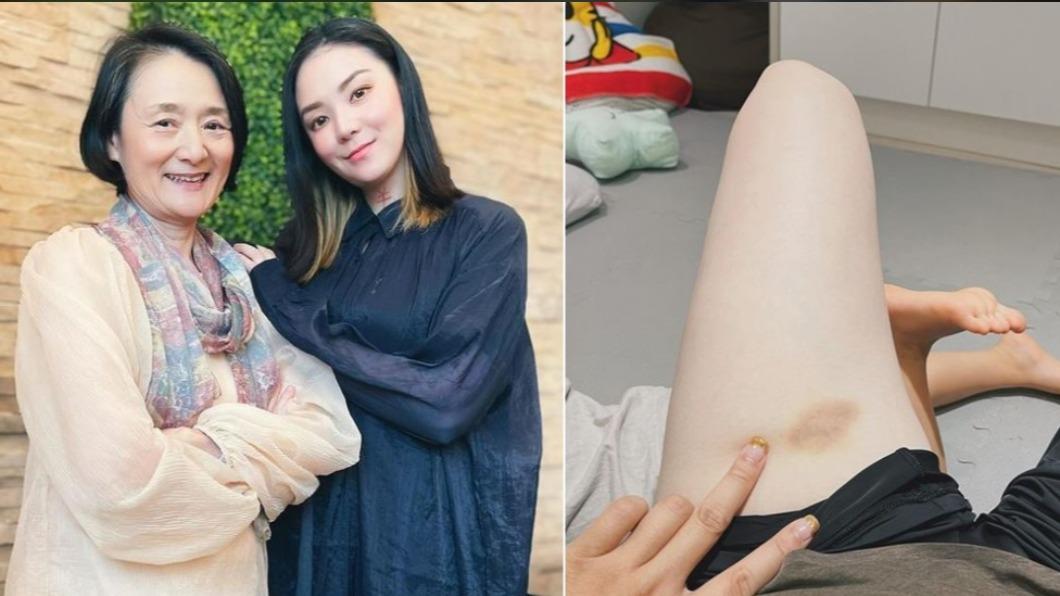 譚艾珍愛女認「我被家暴」!大腿整片瘀青 還原驚悚過程