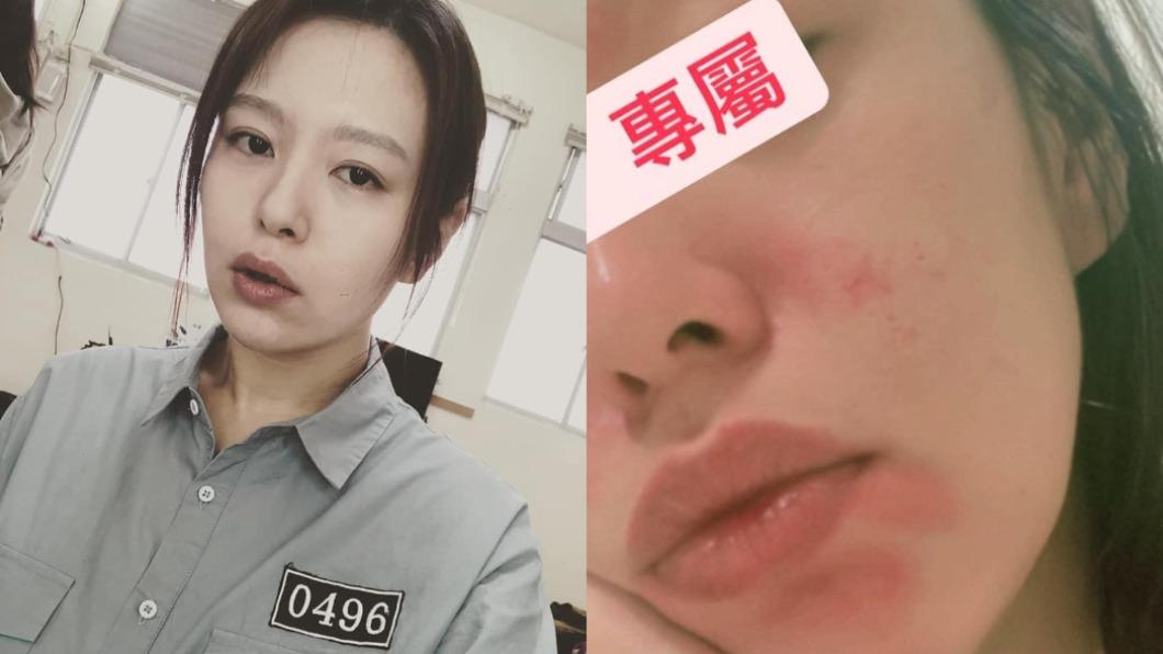 劉品言失手了!皮膚紅腫成「大花臉」哀號:濾鏡都擋不住